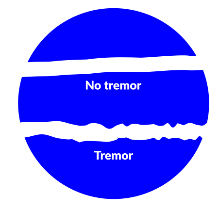 Tremor